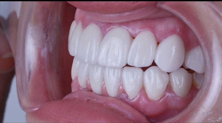 بعد تركيبات-اسنان